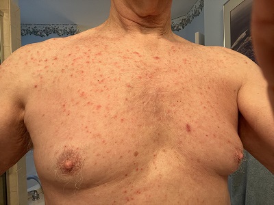 Fred's Chest with Grover's Disease