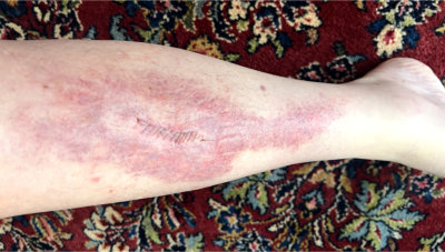Fred's leg showing rash from adhesive tape